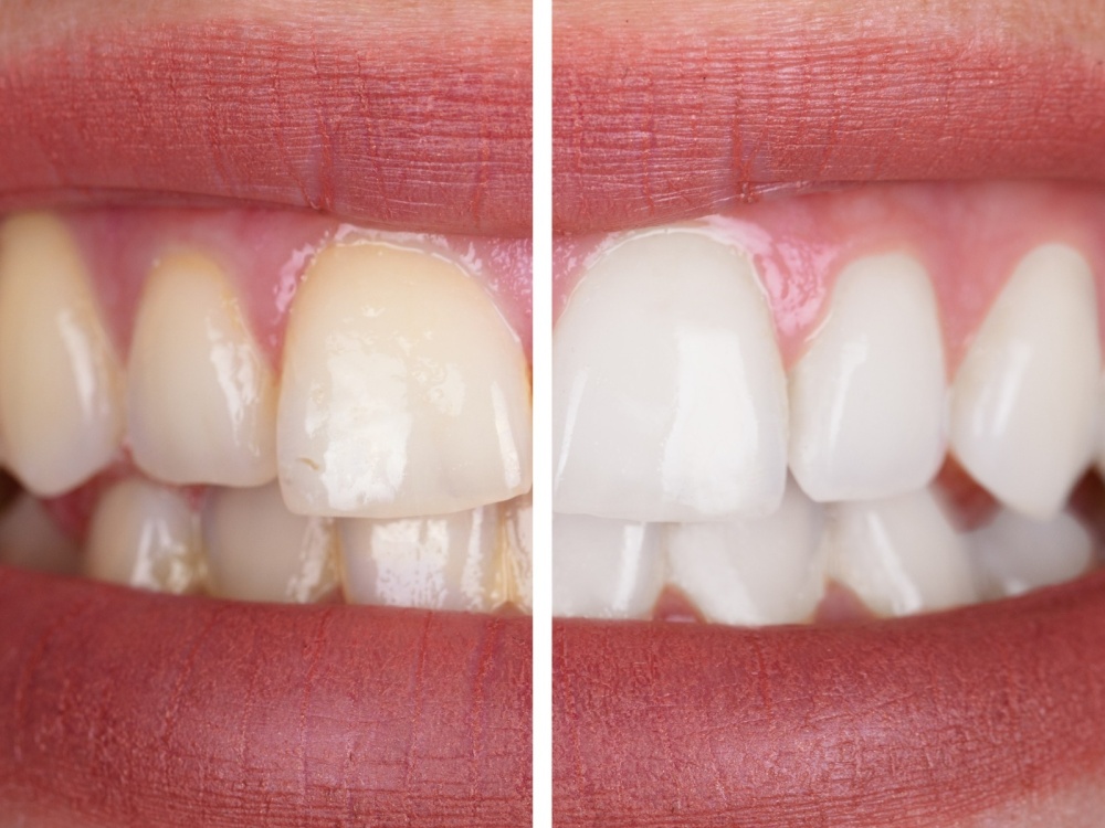 Sbiancamento dentale Padova 